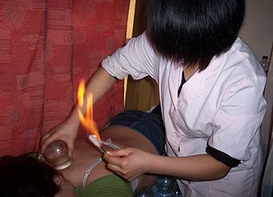 cupping therapy calgary